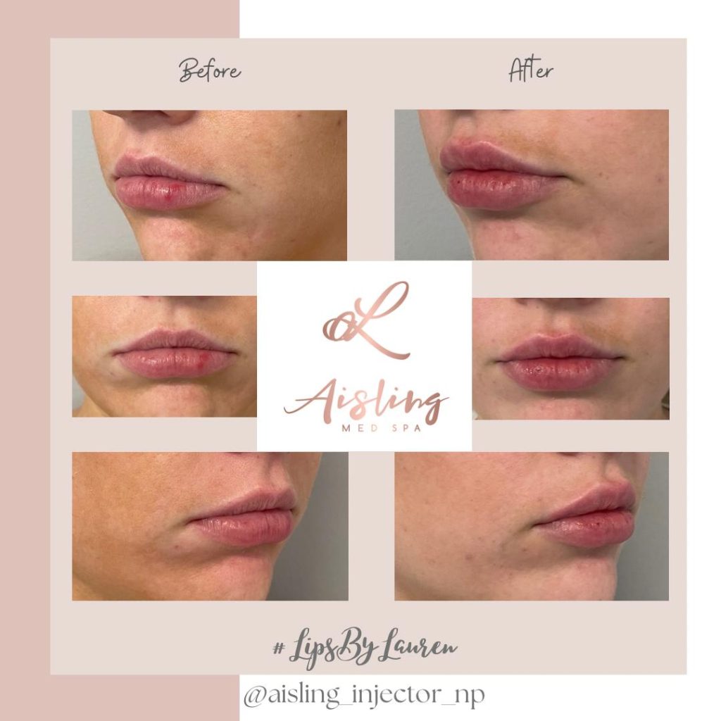 Before and after lip filler enhancement at Aisling Med Spa.