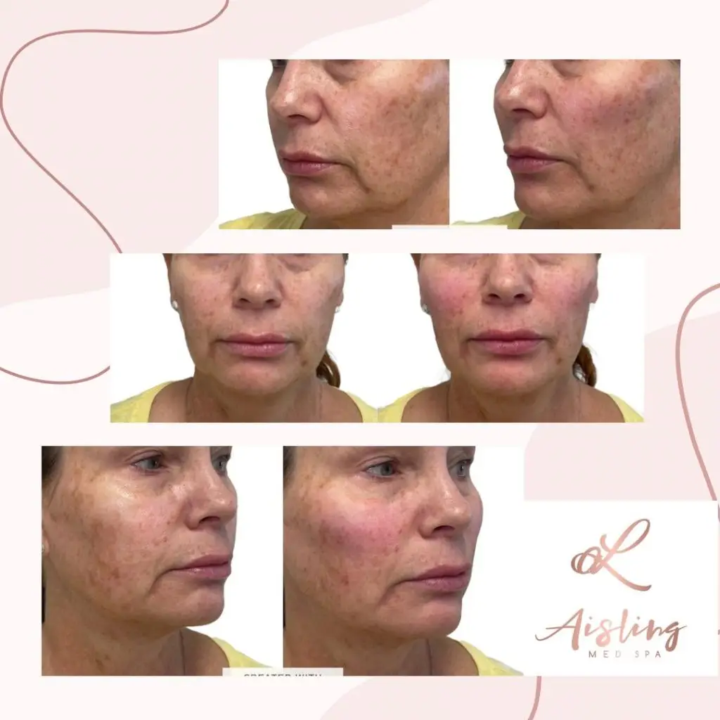 Before and after facial treatment at spa.