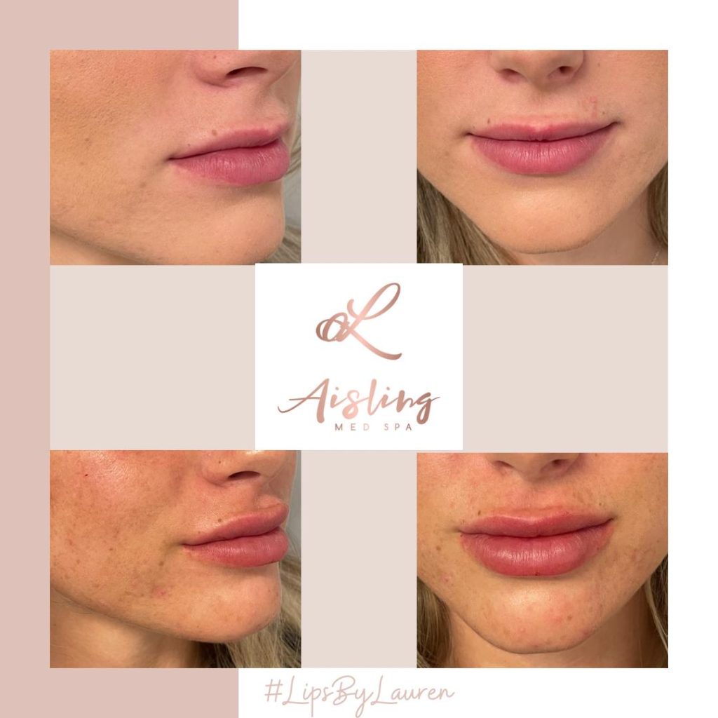 Lips enhancement results from Aisling Med Spa.