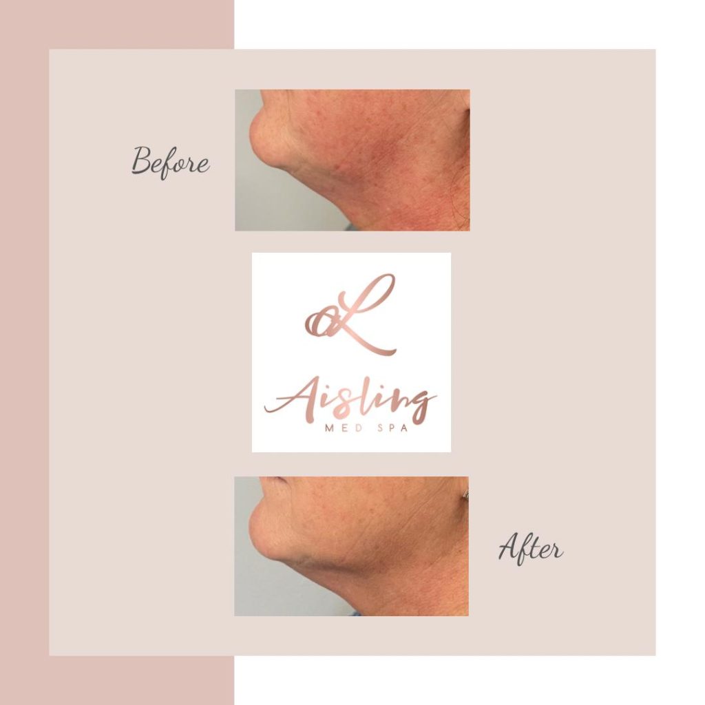 Before and after comparison of chin contouring results.