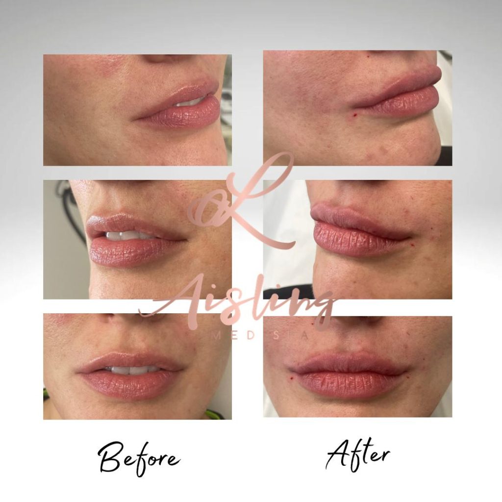 Before and after lip enhancement with visible texture improvement.