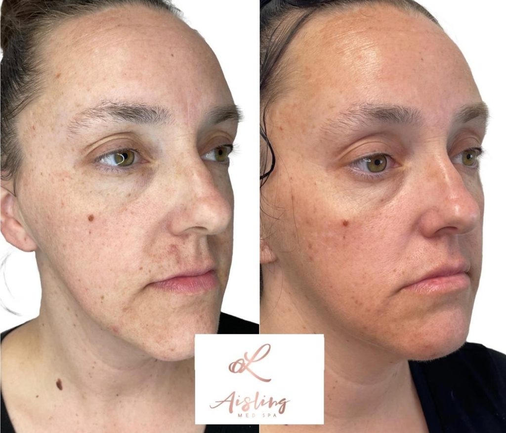 Before-and-after spa treatment showing improved skin texture.