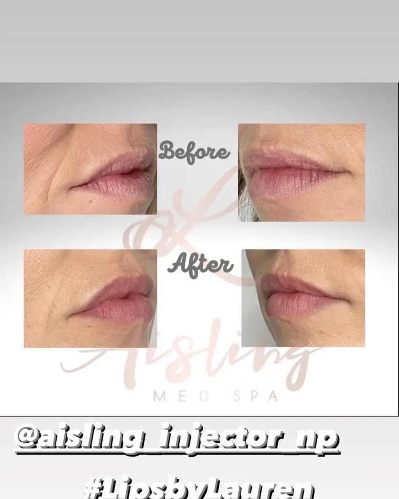 Lip enhancement results: before and after comparison.