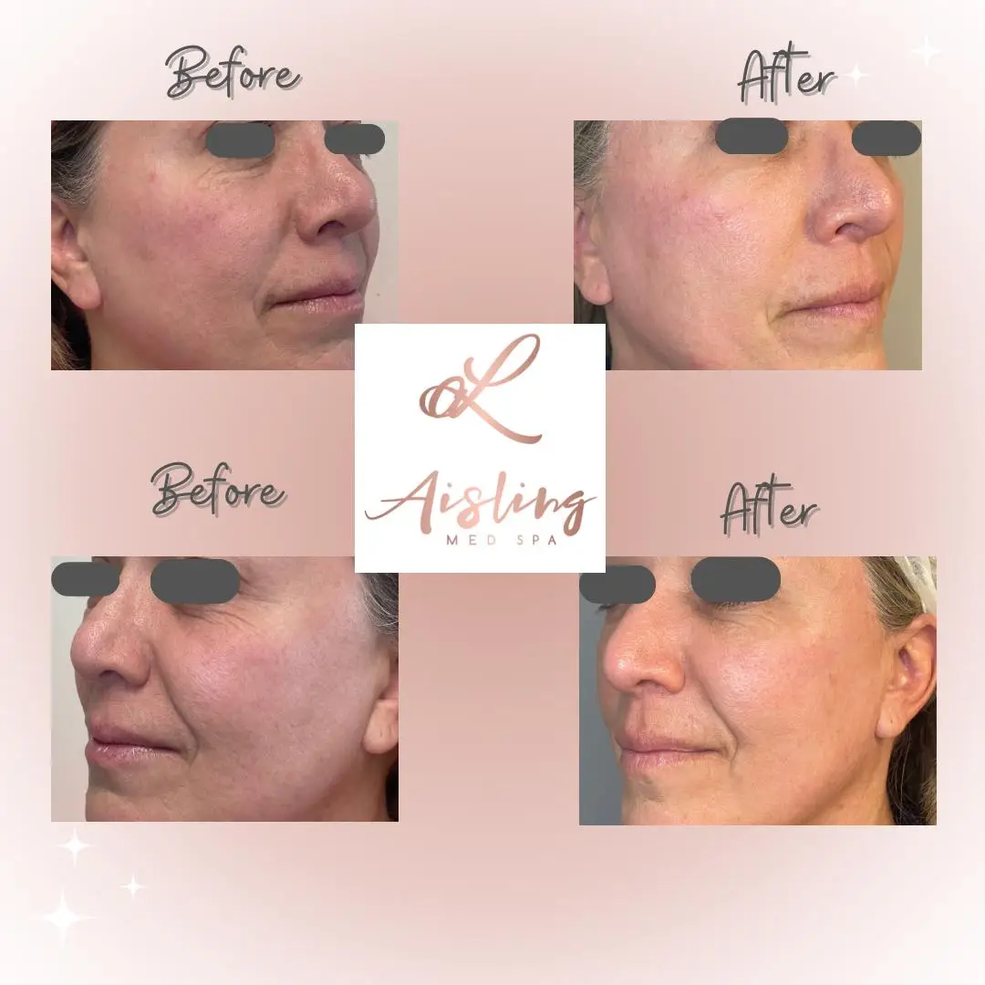Before and after skincare treatment results at Aisling Med Spa.