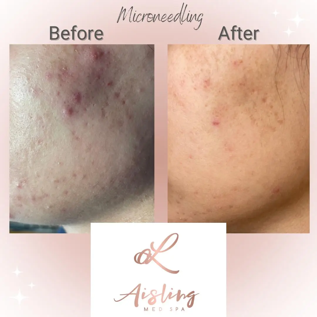 Before and after microneedling treatment showing skin improvement.