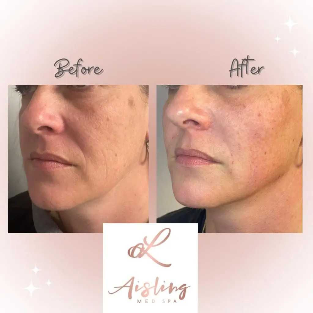 Before and after facial skin treatment results.
