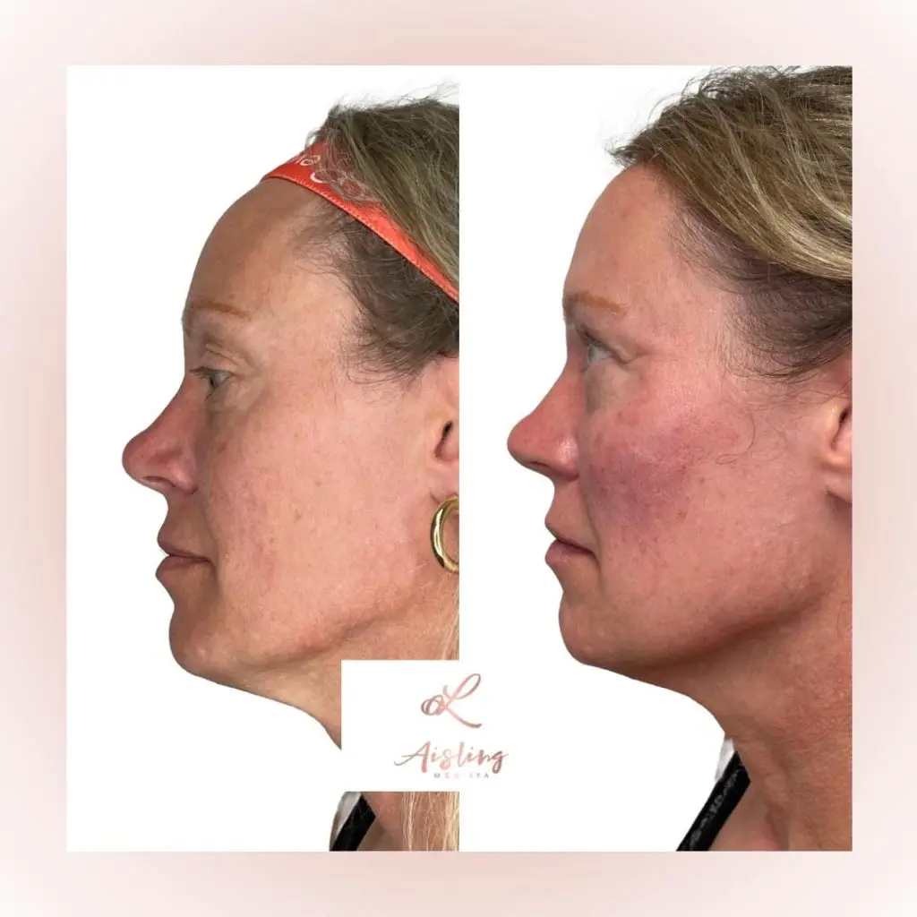 Side profile of woman's face, before and after skin treatment.
