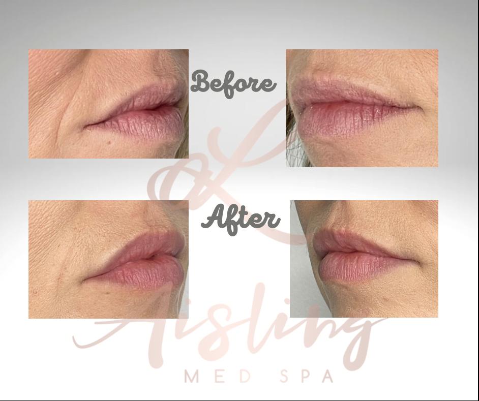 Lip enhancement before and after photos.