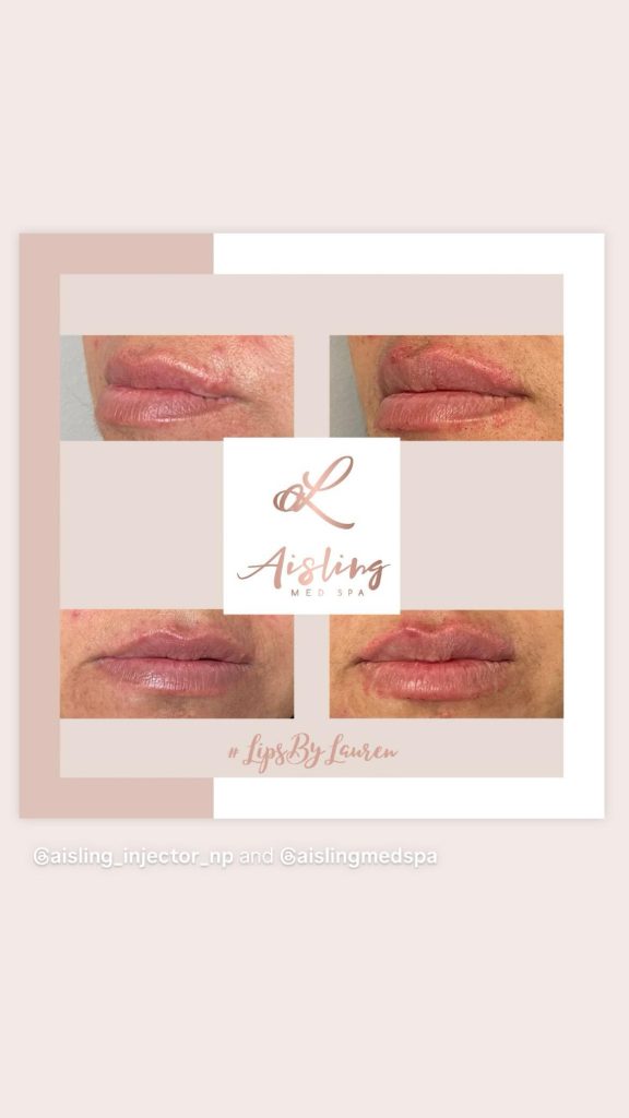 Before and after lip filler results at Aisling Med Spa.