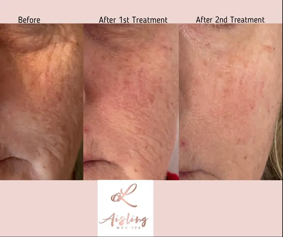 Skin improvement after two spa treatments.