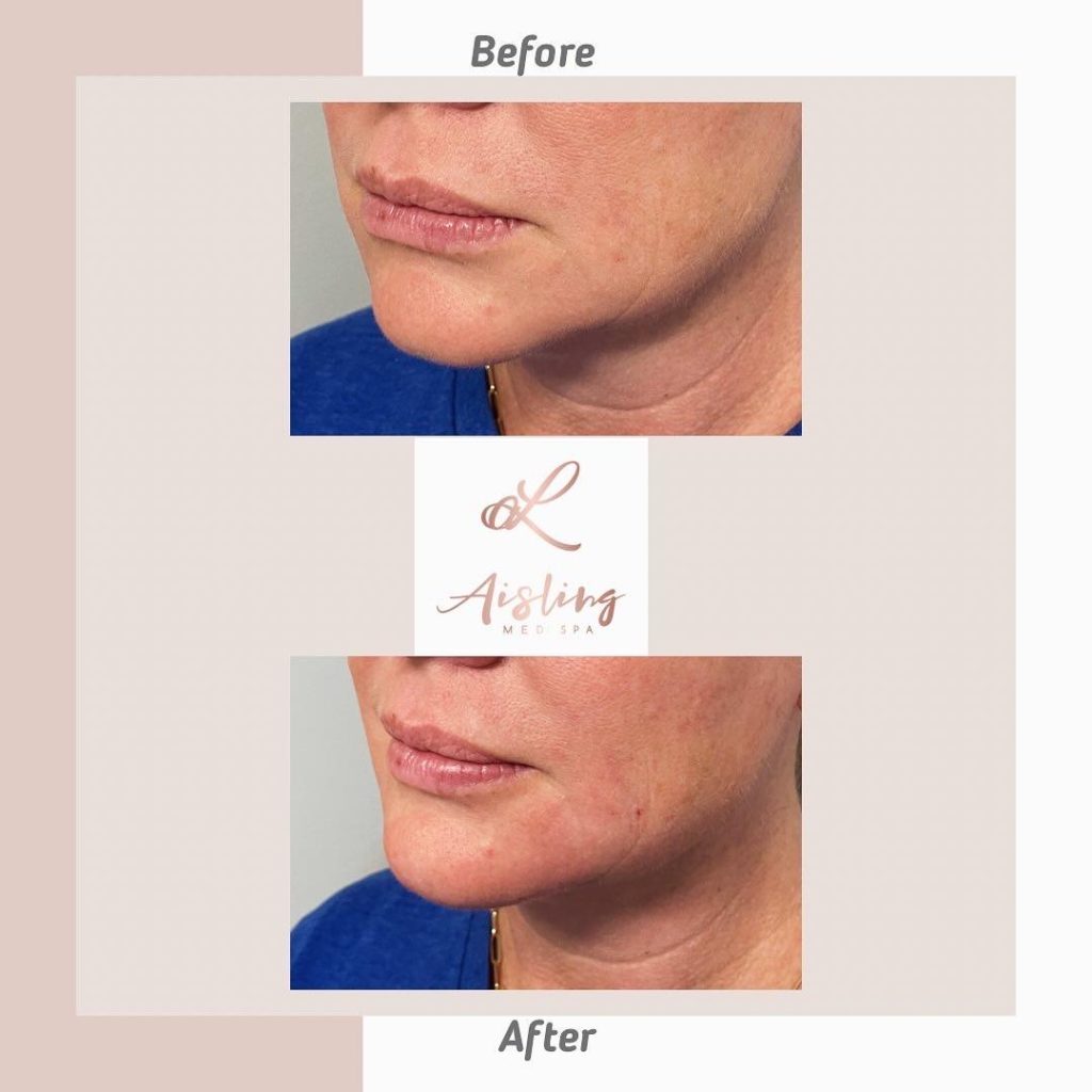 Before and after spa treatment on woman's facial skin.