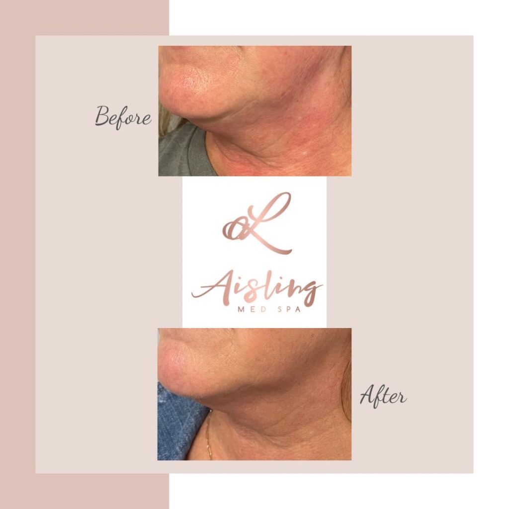 Before and after spa treatment reduces skin redness.