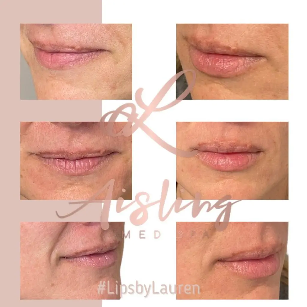 Before and after lip treatment transformation.