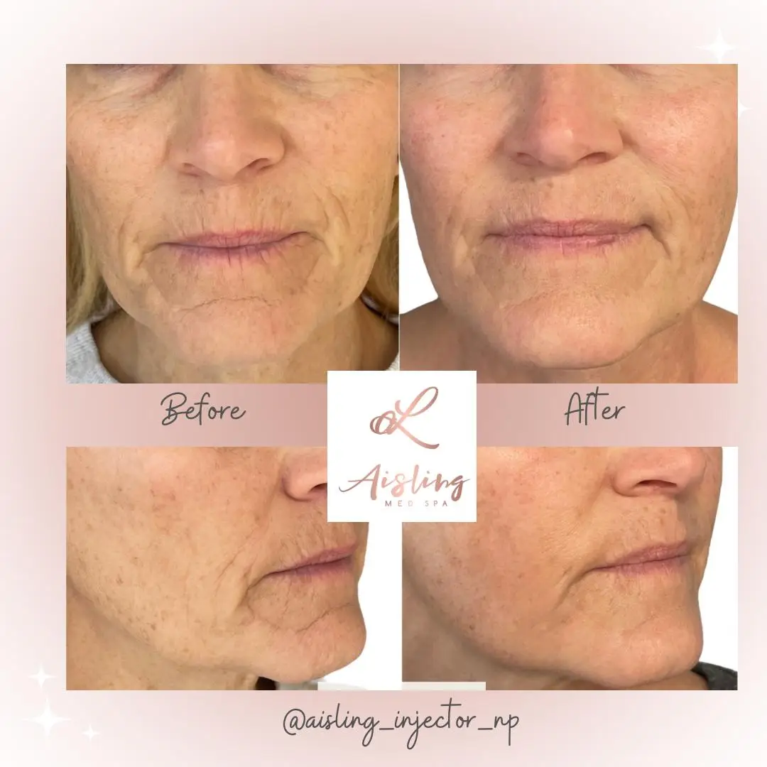 Facial rejuvenation results: reduced wrinkles, smoother skin before and after.