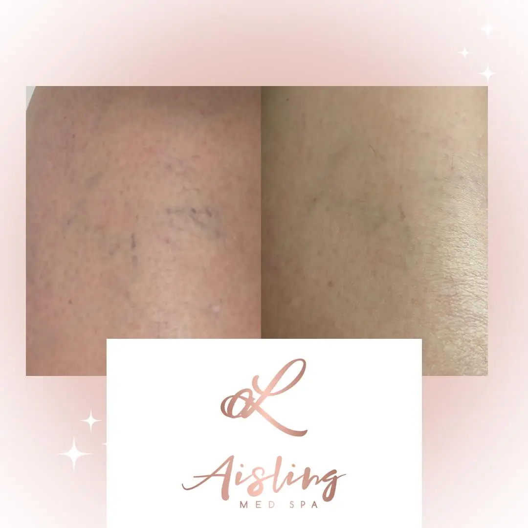 Before and after skin treatment results at Aisling Med Spa.