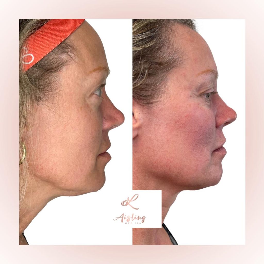 Side-by-side profile showing facial treatment results.