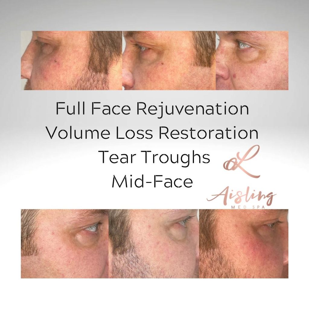 Facial rejuvenation before and after male patient close-ups.