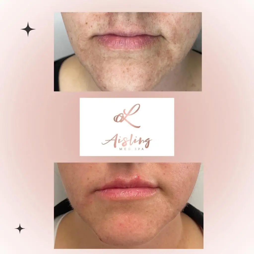 Before and after facial treatment showing improved skin texture.