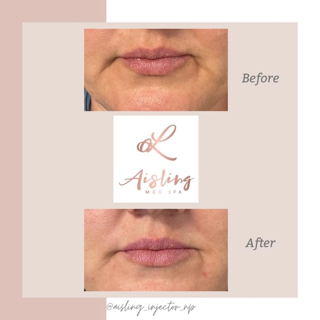 Lip enhancement results, before and after comparison.