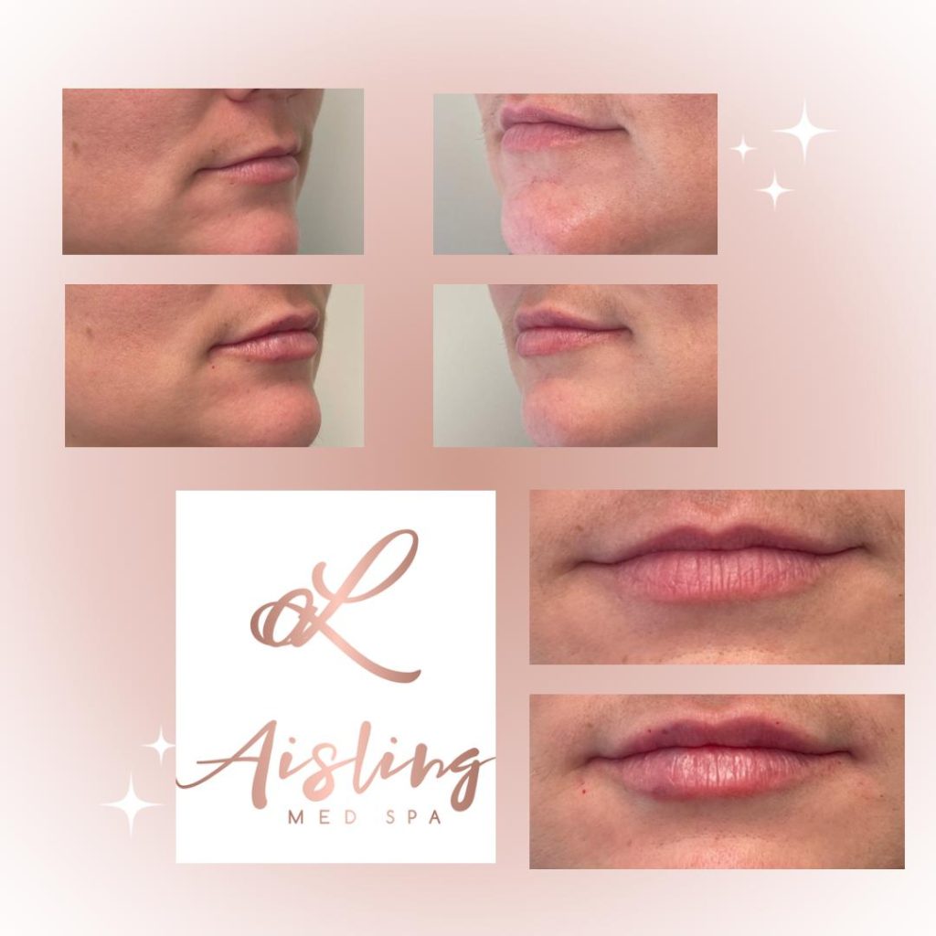 Before and after lip enhancement results.