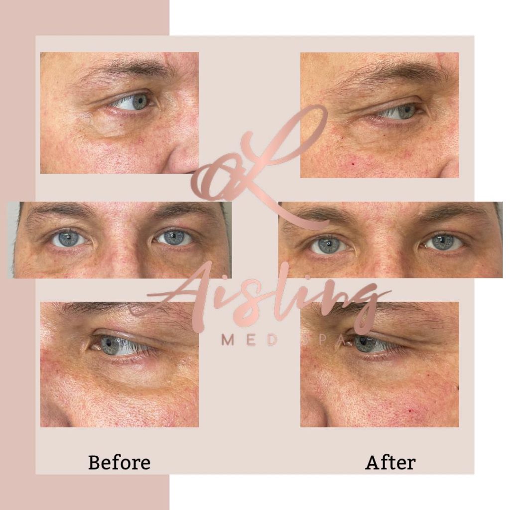 Before and after age spot treatment results around eyes.