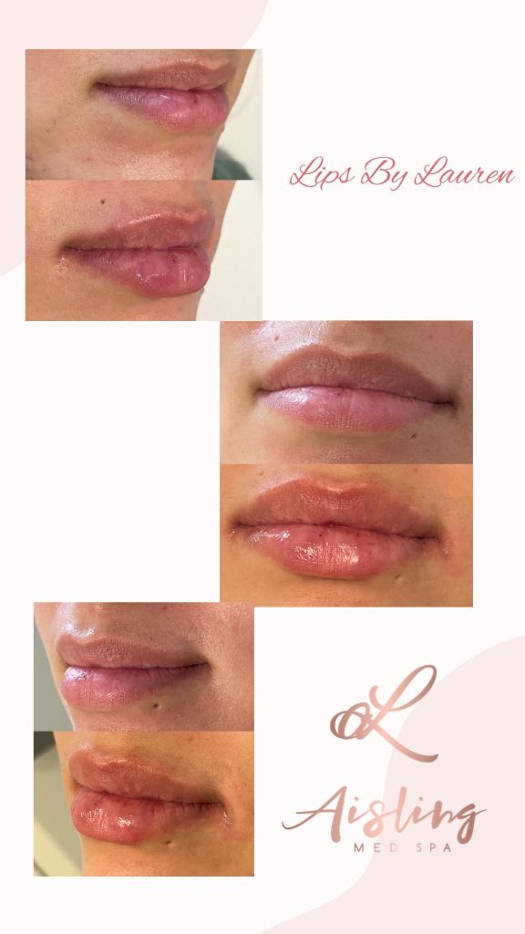Before and after lip enhancement results at Aisling Med Spa.