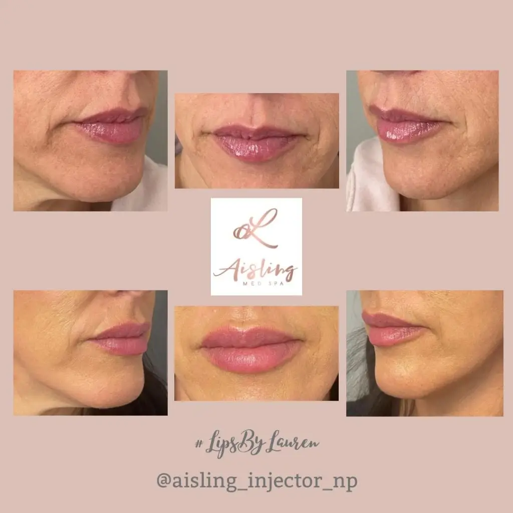 Lip enhancements before and after treatment at Aisling Med Spa.