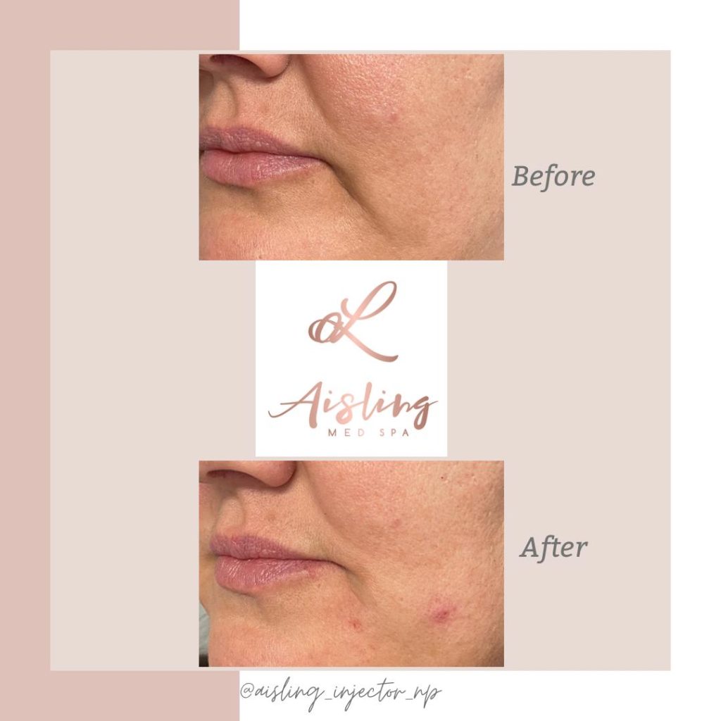 Before and after lip enhancement at Aisling Med Spa.