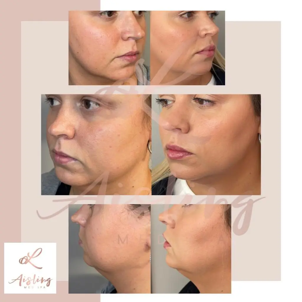 Before and after facial treatment, visible skin improvement.