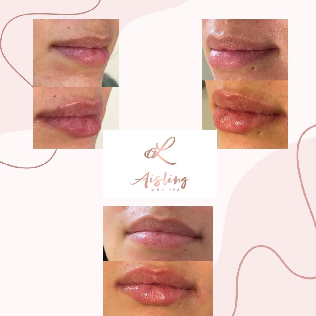 Before and after lip enhancement results at Aisling Med Spa.