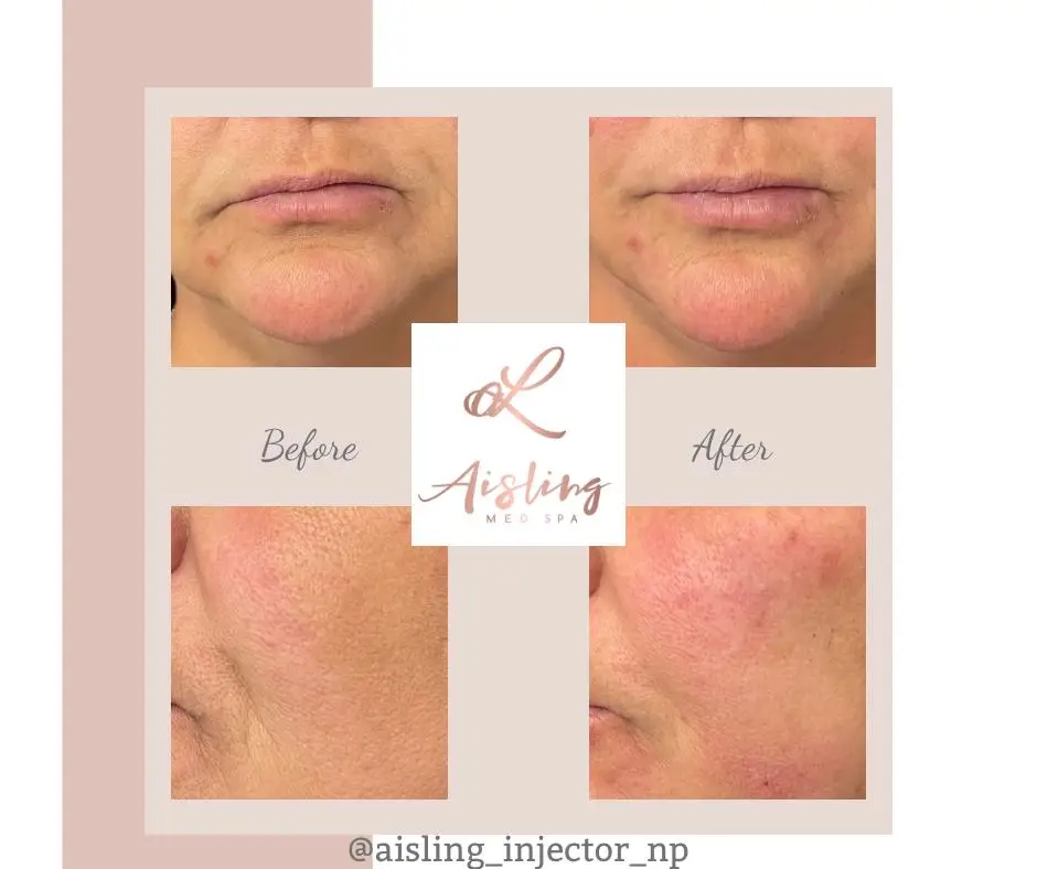 Before and after facial treatment results at Aisling Med Spa.