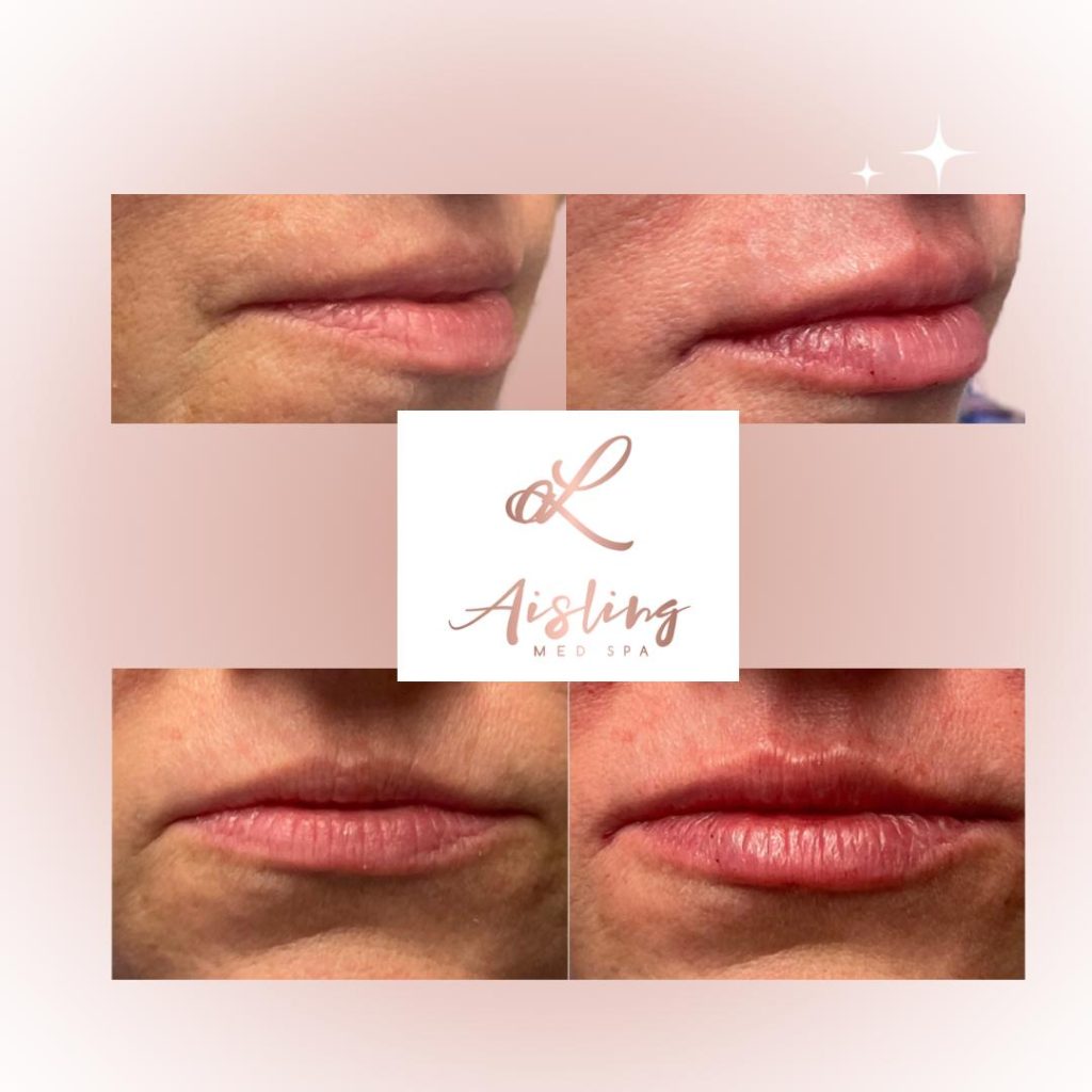 Four images showing before and after lip enhancements at a med spa.
