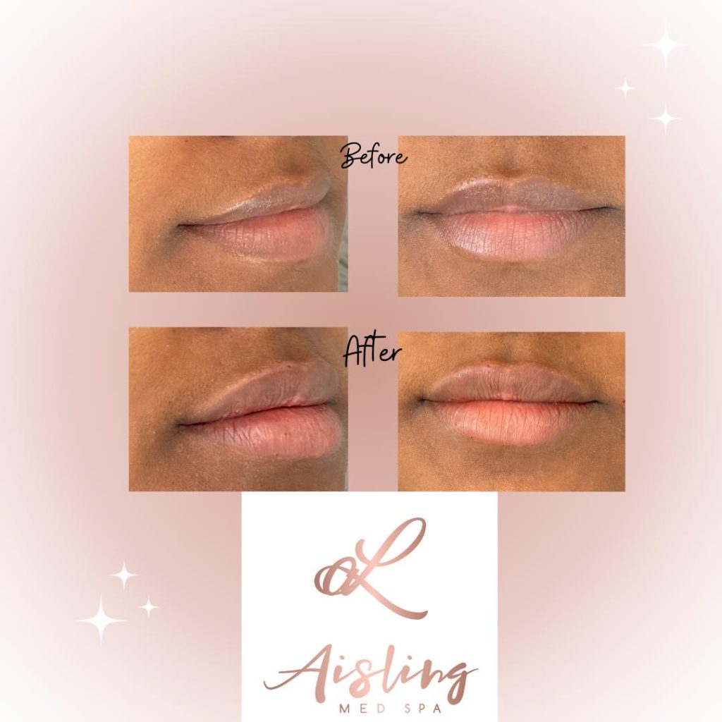 Before and after lip enhancement at Aisling Med Spa.