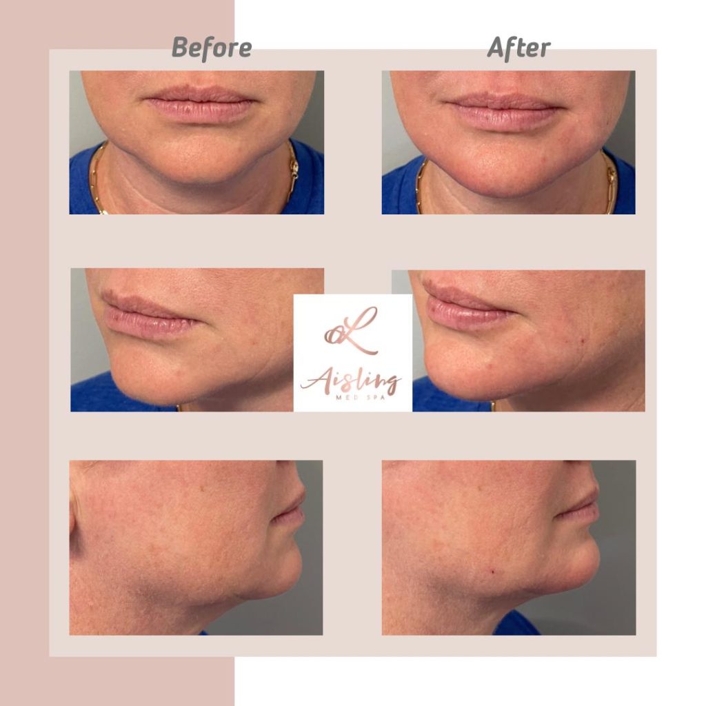Before and after images of facial treatment results.