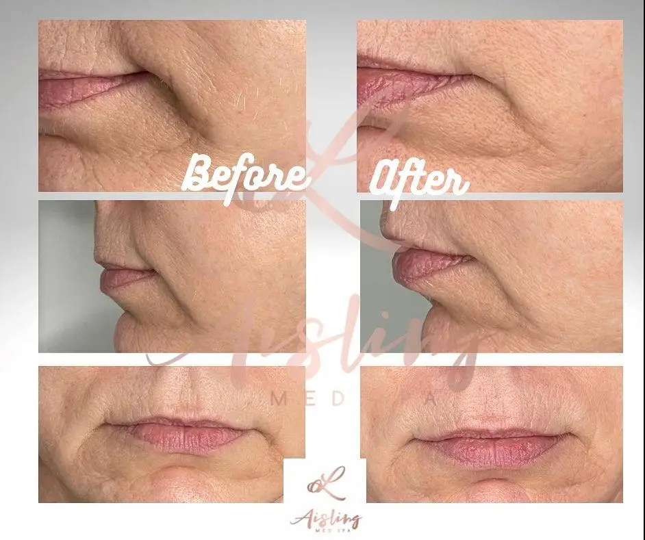 Before and after images showing improved skin texture.