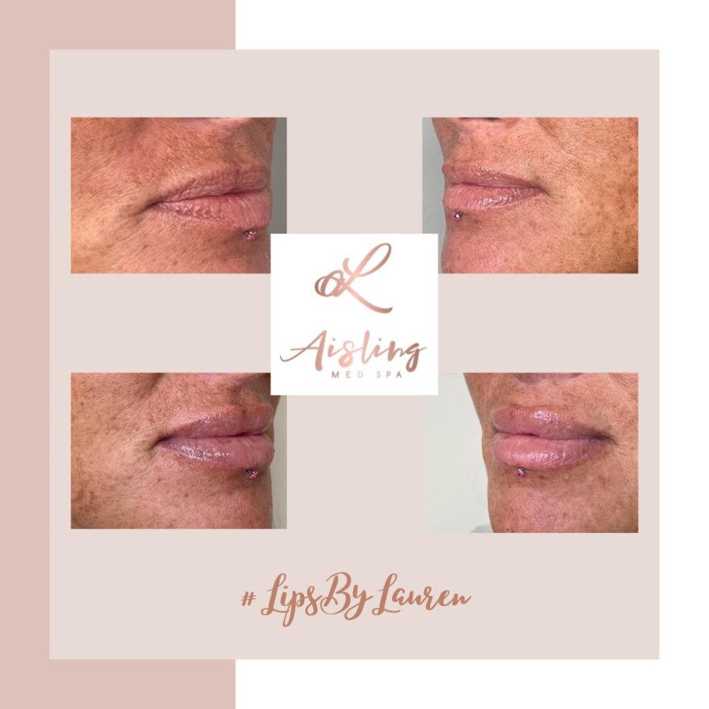 Before and after lip enhancement at Aisling Med Spa.