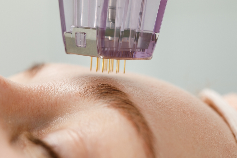 Microneedling device applied to forehead skin.