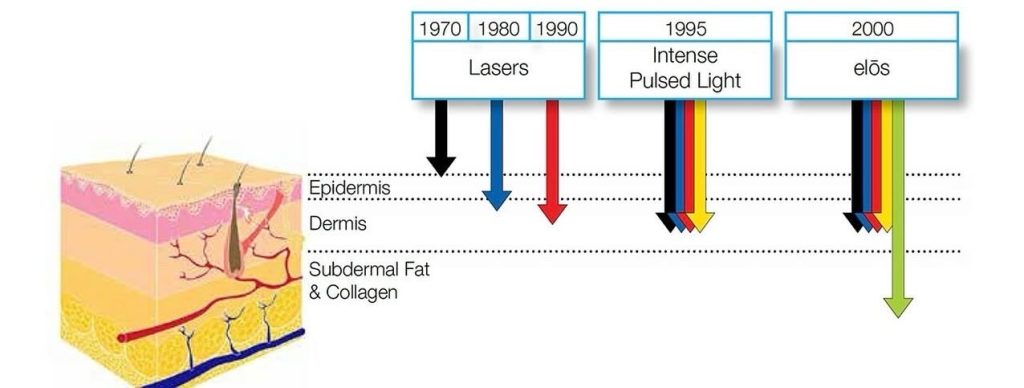 Skin layer diagram with laser and light technology penetration timeline.