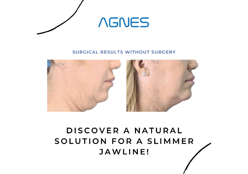 Side-by-side comparison of a woman's jawline before and after treatment.