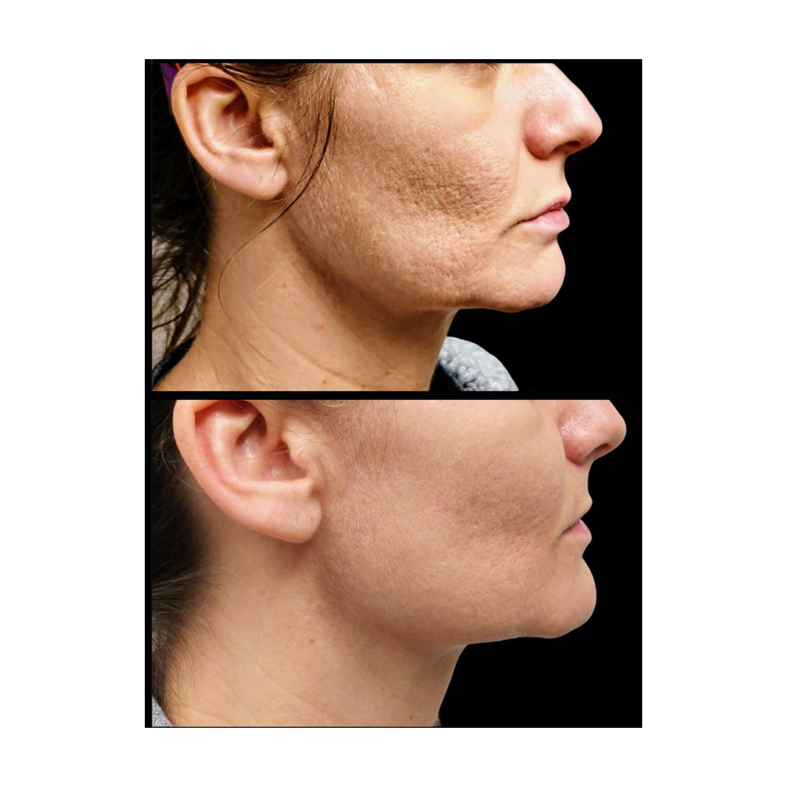 Before and after acne scar treatment on woman's cheek.