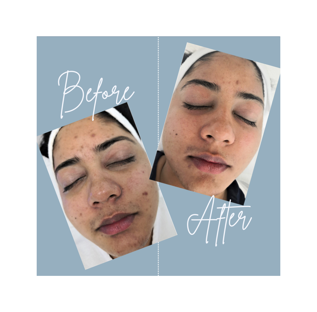 Before and after facial treatment comparison.