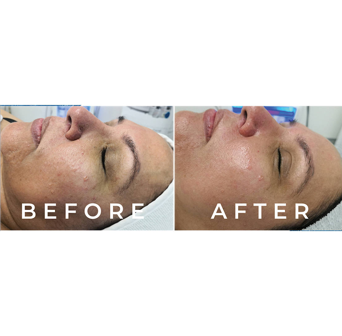 Before and after facial treatment results.