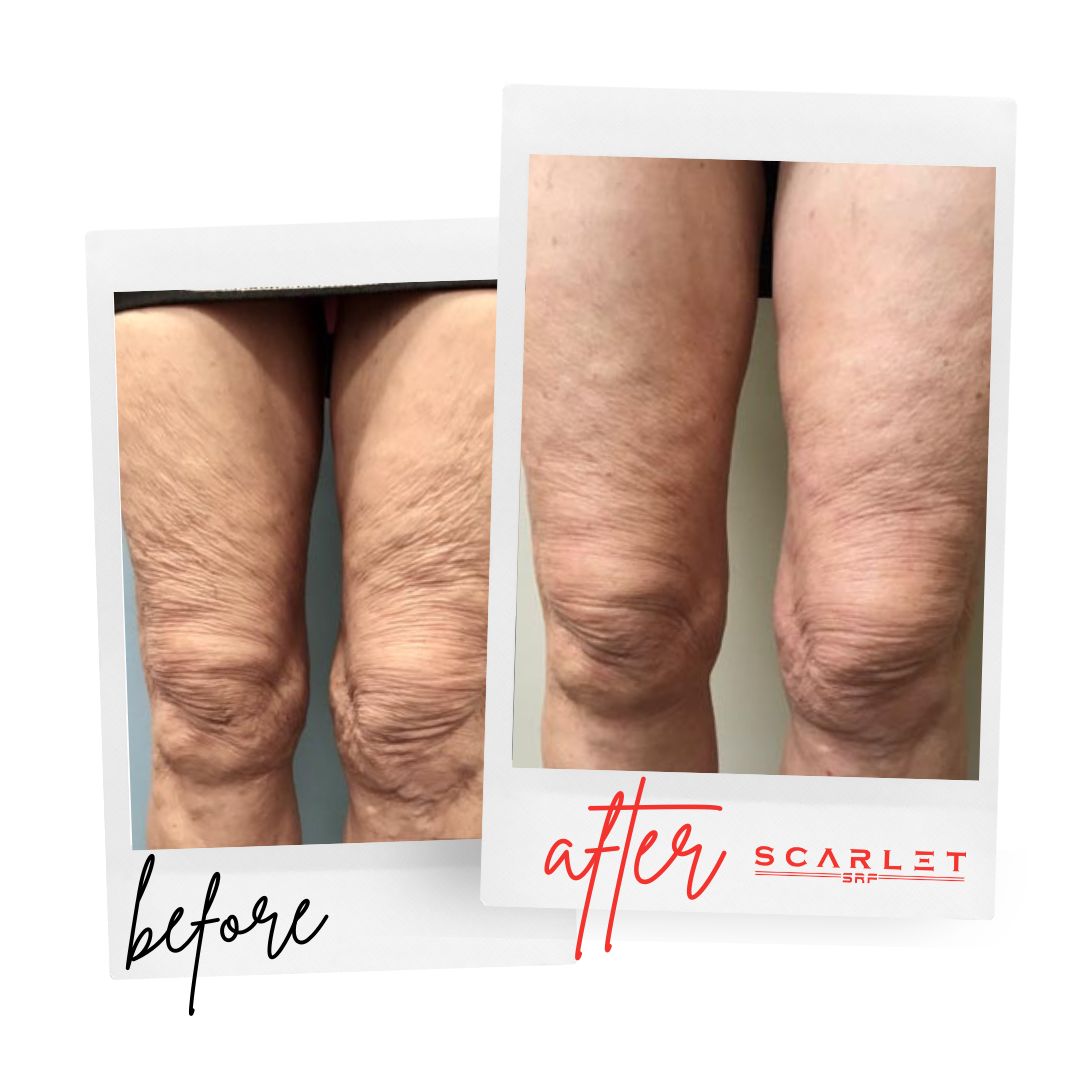 Before and after leg skin treatment with improved appearance.